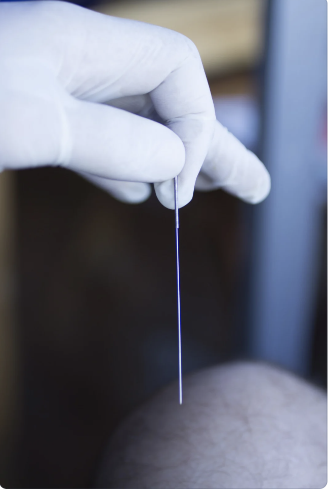 dry needling theraphy